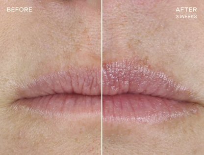 Replenishing Lip Filler